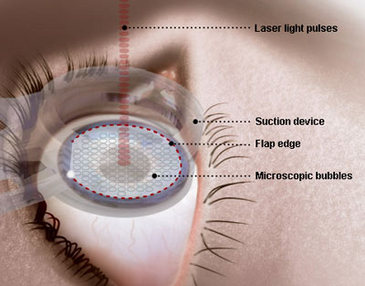 lazer göz ameliyatı aşamaları